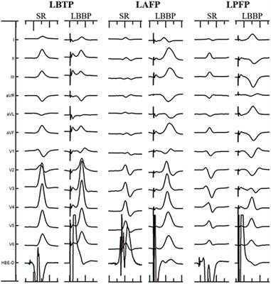 A Comparison of the Electrophysiological and Anatomic Characteristics of Pacing Different Branches of the Left Bundle Conduction System